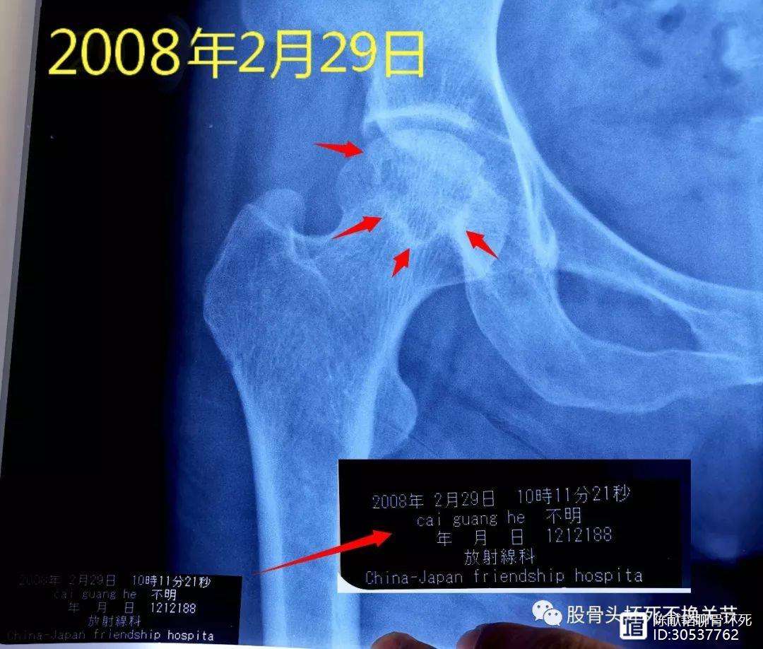 深圳人工骨头医保报销多少(人工骨头医保报销多少比例)